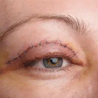 بلفاروپلاستی و خدمات لاغری و زیبایی اندام|خدمات آرایشگری و زیبایی|کرمانشاه, |دیوار