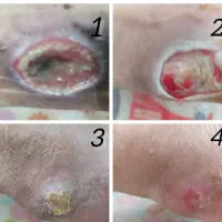 کارشناس درمانگر تخصصی زخم ،مراقب و پرستار در منزل