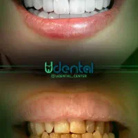 کامپوزیت، لمینت، ایمپلنت اقساط ویژه|خدمات آرایشگری و زیبایی|ایلام, |دیوار