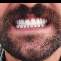 دندان مصنوعی / ژله ای / اوردنچر /چک صیادی / بیمه|خدمات آرایشگری و زیبایی|کرج, عظیمیه|دیوار