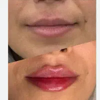 جشنواره تخفیف ژل بوتاکس مزو به مدت کوتاه درکلینیک|خدمات زیبایی و سلامت|اصفهان, ملک‌شهر|دیوار
