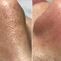 پاکسازی پوست فیشال پوست فیشیال پوست|خدمات آرایشگری و زیبایی|تهران, مجیدیه|دیوار