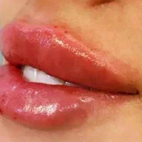 ژل بوتاکس جربی آنزیم مزو پی آرپی مامایی