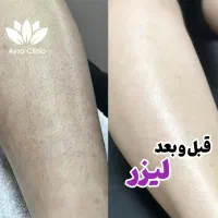 لیزر موهای زائد فول فقط ۳۹۰|خدمات آرایشگری و زیبایی|اصفهان, دوطفلان|دیوار