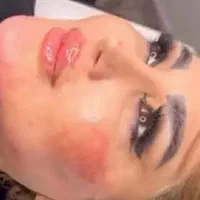 تخفیف 50 درصدی تزریق ژل و بوتاکس|خدمات آرایشگری و زیبایی|ارومیه, |دیوار