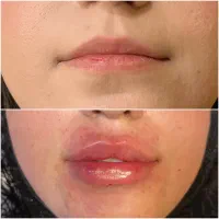 جشنواره تخفیف بوتاکس و فیلر و مزوژل prp