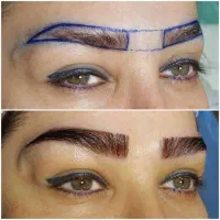 کاشت ابرو درمرکز تخصصی مجوزدار تهران