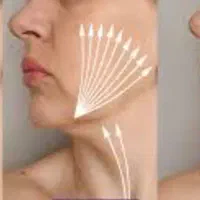تخفیف ویژه لیفت صورت با نخ لیفت و کلاژن|خدمات زیبایی و سلامت|تهران, توحید|دیوار