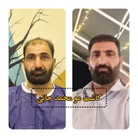 کاشت مو و ابرو و ریش|خدمات آرایشگری و زیبایی|ارسنجان, |دیوار