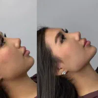 کلینیک تزریق ژل و بوتاکس مزو آنزیم فیلر