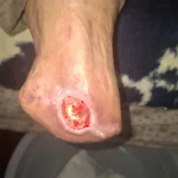 درمان زخم و پانسمان نوین