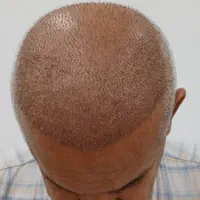 کاشت مو طبیعی در بوشهر وشیراز|خدمات آرایشگری و زیبایی|بوشهر, |دیوار