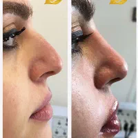 تزریق آنزیم و فیلر بینی|خدمات آرایشگری و زیبایی|تهران, پاسداران|دیوار