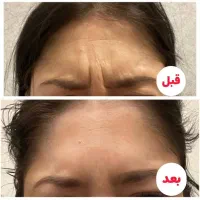 کرم بوتاکس پنج کاره گاتیو|آرایشی، بهداشتی، درمانی|تهران, مشیریه|دیوار