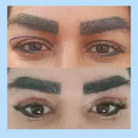 بلفاروپلاستی ۵.۵۰۰ ساده و لیزری،لیفت صورت و ابرو