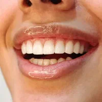کامپوزیت/ ایمپلنت/ اقساط ۴ ماهه