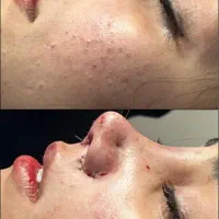 اف عمل زیبایی بینی