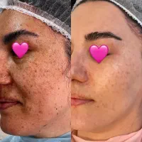 فیشال تخصصی پوست آقایان و بانوان