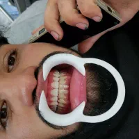 کامپوزیت دندان هر فک 5تومن|خدمات آرایشگری و زیبایی|محمدشهر, محمدشهر|دیوار