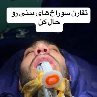 عمل بینی با متخصص بالای ۱۰۰۰ عمل موفق فقط با ۲۳ م|خدمات آرایشگری و زیبایی|تهران, جمال‌زاده|دیوار