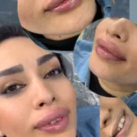 تزریق فیلر و بوتاکس|خدمات آرایشگری و زیبایی|اهواز, گلستان|دیوار
