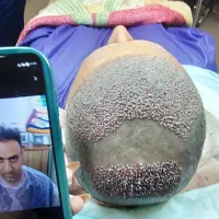 جشنواره پاییزه کاشت مو|خدمات زیبایی و سلامت|کرمانشاه, |دیوار