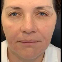 جشنواره تخفیف جراحی لیفت صورت|خدمات آرایشگری و زیبایی|کرج, مهرویلا جنوبی|دیوار