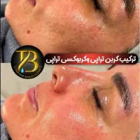 روشن‌کننده هایفو لیزرموزائد پی‌آر‌پی حجم‌سینه‌باسن|خدمات آرایشگری و زیبایی|تهران, صادقیه|دیوار