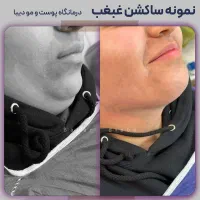 ساکشن غبغب،بلفاروپلاستی،تزریق چربی+قیمت|خدمات آرایشگری و زیبایی|قم, باجک یک|دیوار