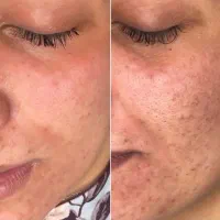 پاکسازی ۱۲مرحله با هدیه درما ۱۹۸ تومان( کلینیک)|خدمات آرایشگری و زیبایی|بیرجند, |دیوار