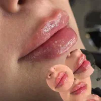 لیزر مو های زائد بوتاکس ژل لب کربن تراپی ریموو تتو