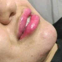 ژل بوتاکس|خدمات آرایشگری و زیبایی|دوگنبدان, |دیوار