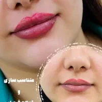 تزریق ژل بوتاکس فیشال توسط پزشک|خدمات آرایشگری و زیبایی|برازجان, |دیوار