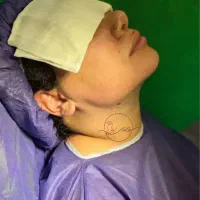 ساکشن غبغب بایوفیلر لیفت جوانساز اقساط چک|خدمات آرایشگری و زیبایی|اصفهان, سیچان|دیوار