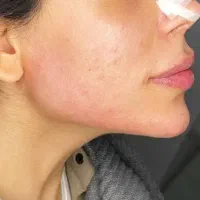 *جشنواره * تخفیف کلینیک زیبایی|خدمات آرایشگری و زیبایی|قرچک, شهرک طلائیه|دیوار