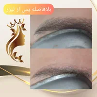 ریموو تتو با لیزر کیوسوئیچ و روشن سازی نواحی تیره|خدمات آرایشگری و زیبایی|قم, زنبیل آباد|دیوار
