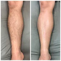 لیزر موی زاید،هایفو فشیال،فیلر مزو  در مطب آلالیزر|خدمات آرایشگری و زیبایی|کرج, حسین‌آباد|دیوار