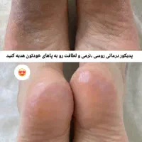 اسپا درمانی کف پا
