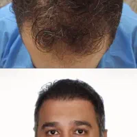 کاشت مو تمام اقساطی وتضمینی در کلینیک تخصصی تبریز|خدمات آرایشگری و زیبایی|ارومیه, |دیوار