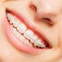 دندان پزشکی/ ایمپلنت بدون بخیه/اوردنچر/روکش|خدمات آرایشگری و زیبایی|تبریز, |دیوار