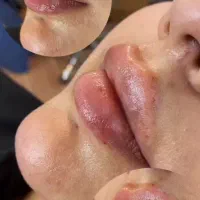 فیلرلب800 فیلربینی1 بوتاکس650