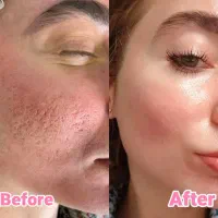 اسید فشیال اسید لک و فشیال تخصصی