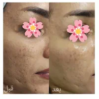 خدمات پاکسازی و جوانسازی پوست|خدمات آرایشگری و زیبایی|لاهیجان, مهرگان|دیوار