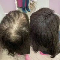 میکرو اسکالپ موی سر ،ریش، ابرو( در محل)