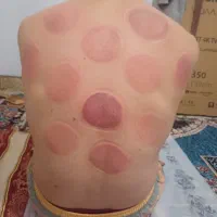 حجامت معجزه میکنه