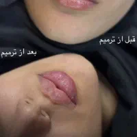 زیبایی چهره هارا ماندگار کن با بوتاکس و فیلر|خدمات آرایشگری و زیبایی|سبزوار, فرهنگیان|دیوار