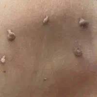 رفع منگوله و ضایعات پوستی