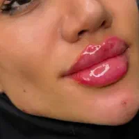 تزریق ژل وبوتاکیس|خدمات آرایشگری و زیبایی|بجنورد, |دیوار