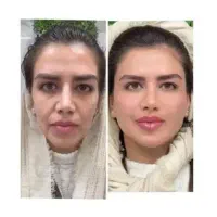 جشنوارلیفت/جوانسازی/هایفو/فقط1جلسه باهدیه عالی۸۹۰