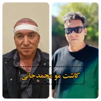 کاشت مو ،ابرو و ریش در شیراز